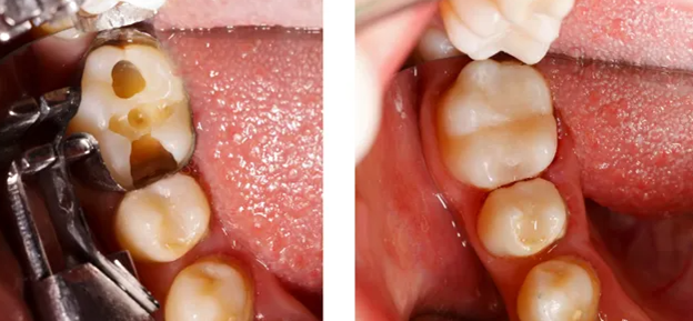 حساسیت دندان بعد از پر کردن