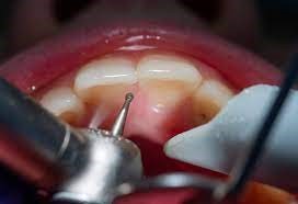 حساسیت دندان بعد از پر کردن
