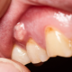 11 80x80 - آیا دندان های شما بعد از پر کردن حساس شده اند؟