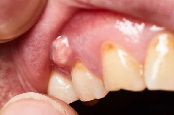 11 - آیا ممکن است زیر روکش دندان پوسیده شود؟