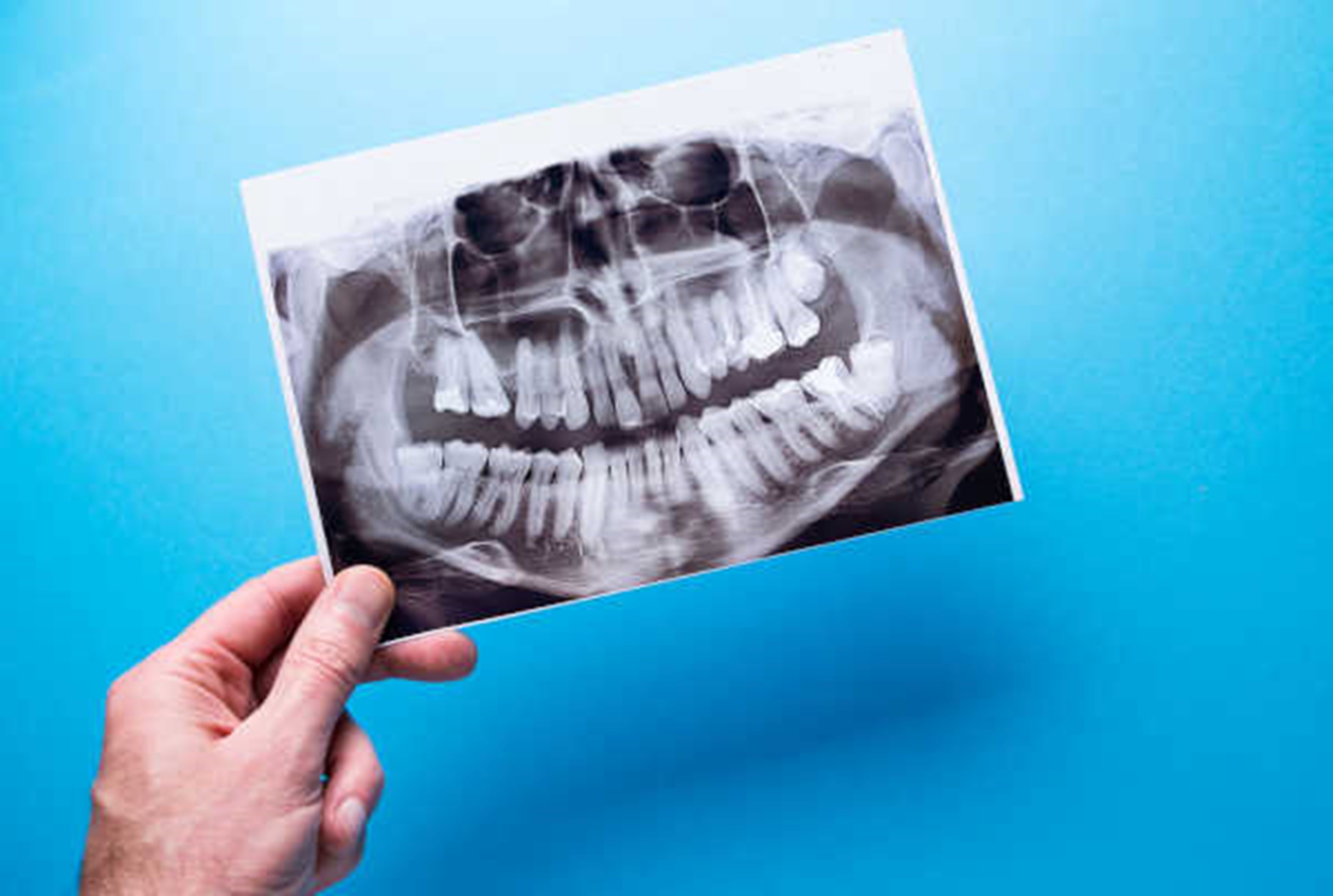 تصاویر رادیوگرافی پانورامیک در دندانپزشکی