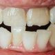 1 80x80 - آیا در طول درمان ارتودنسی باید به دندانپزشک مراجعه کرد؟