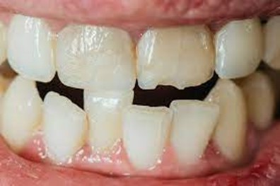 1 - شکستگی یا ترک خوردن دندان