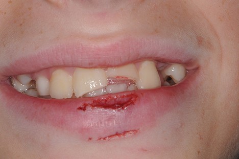 شکستگی یا ترک خوردن دندان