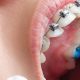 13 80x80 - آیا حساسیت دندان ها در طول درمان ارتودنسی طبیعی است؟