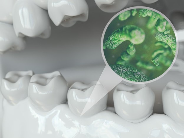 5 - باکتری های پلاک چگونه باعث بیماری لثه و پوسیدگی دندان می شوند؟