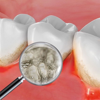 باکتری عامل پوسیدگی دندان