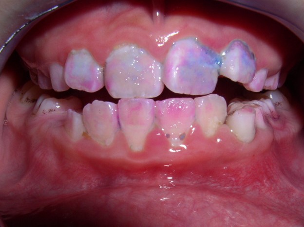 باکتری عامل پوسیدگی دندان