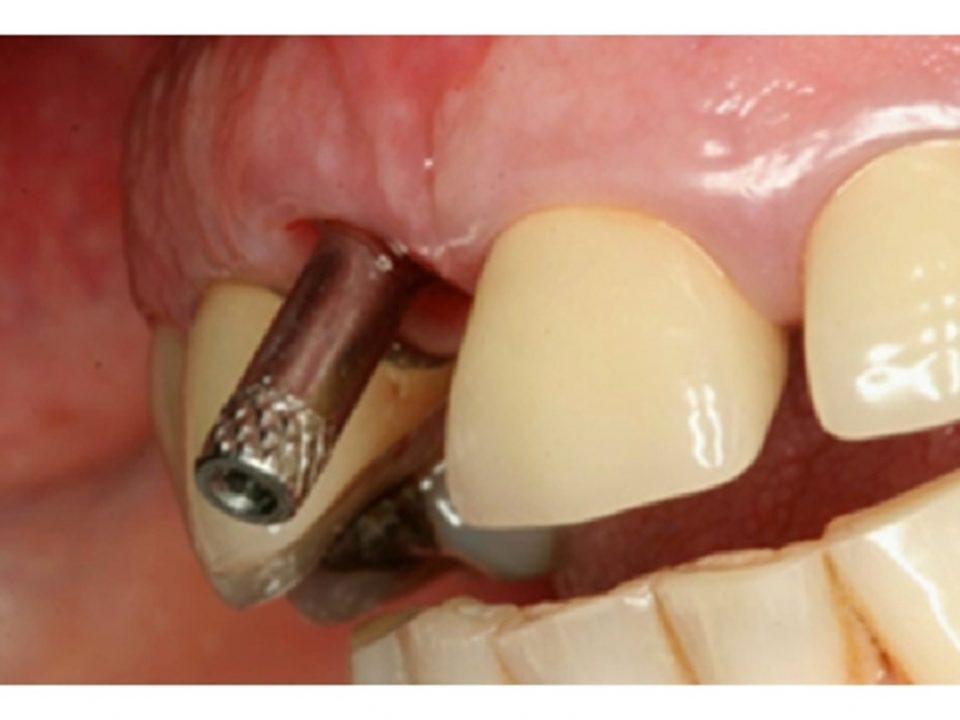 36 960x720 - اصلاح ایمپلنت های دندانی نامناسب