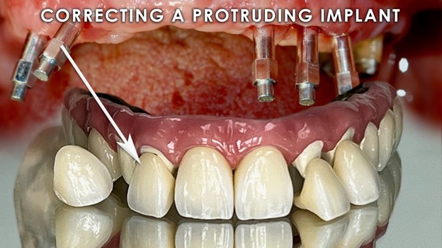 اصلاح ایمپلنت  دندانی نامناسب