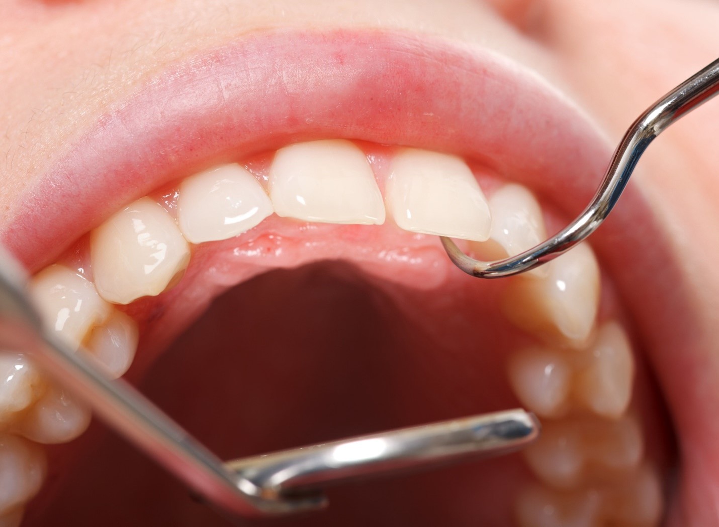 نقش هورمون در سلامت دهان و دندان 