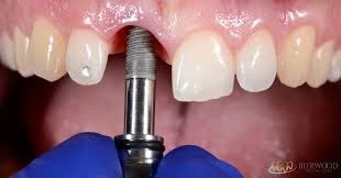 35 - بایدها و نبایدها بعد از کاشت ایمپلنت های دندانی