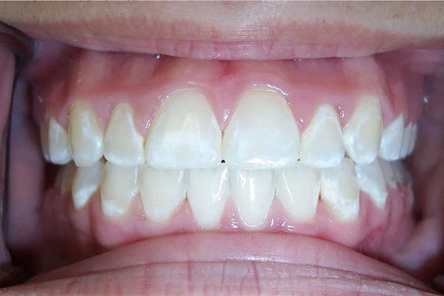 مشکلات بعد از سفید کردن دندان