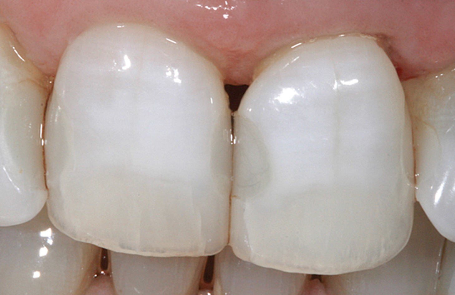 مشکلات بعد از سفید کردن دندان