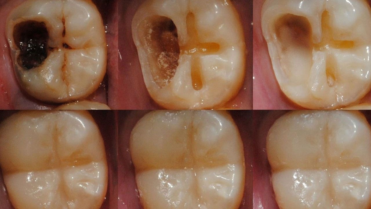 پنج درمان طبیعی برای جبران آسیب دندان