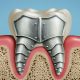 0 min 80x80 - آیا می توان آسیب های دندانی را به طور طبیعی معکوس کرد؟