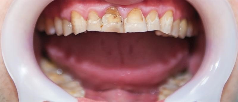 چه عواملی باعث ضعیف شدن دندان ها می شوند؟