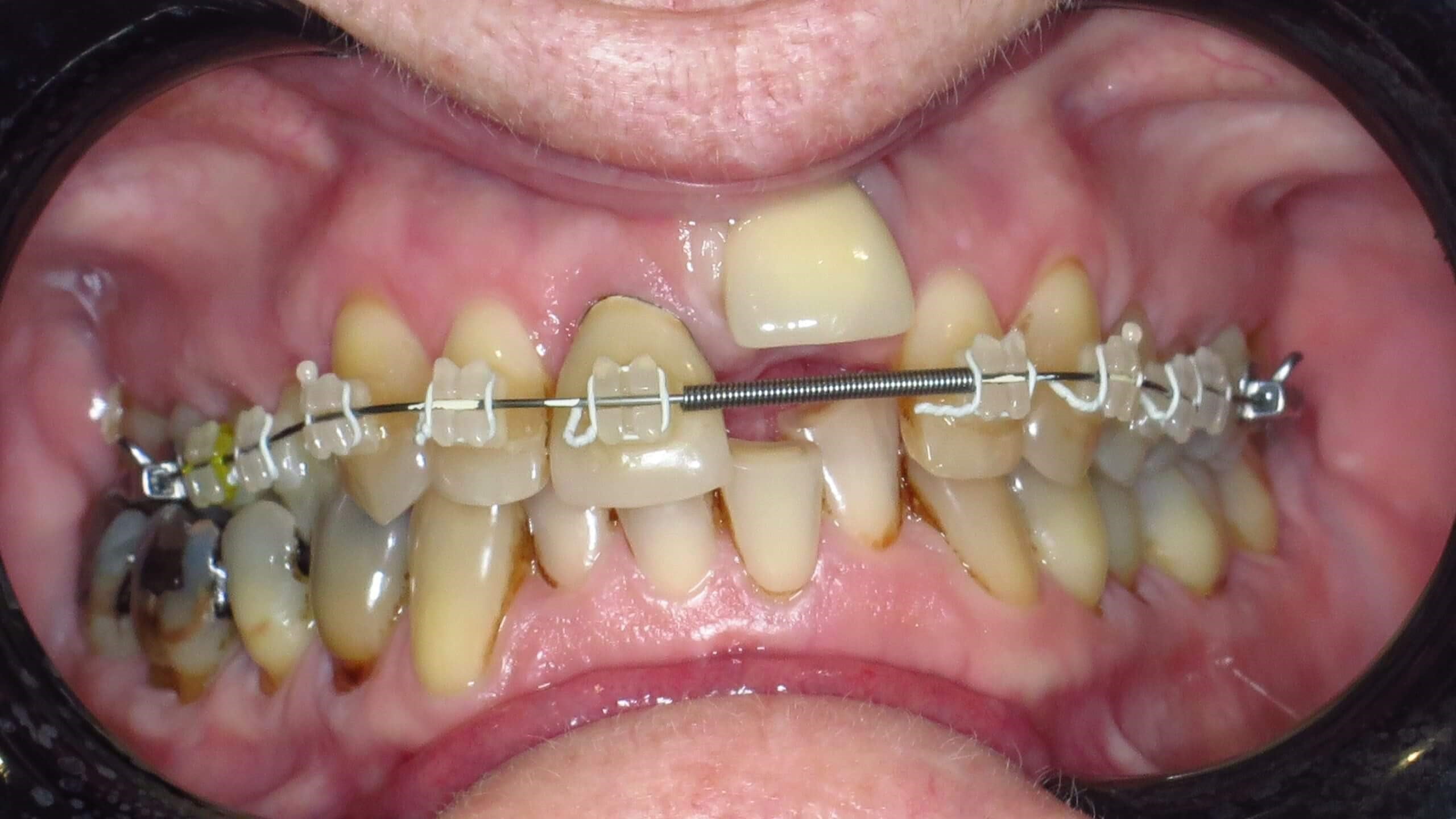 گزینه های تخصصی برای تقویت دندان ها