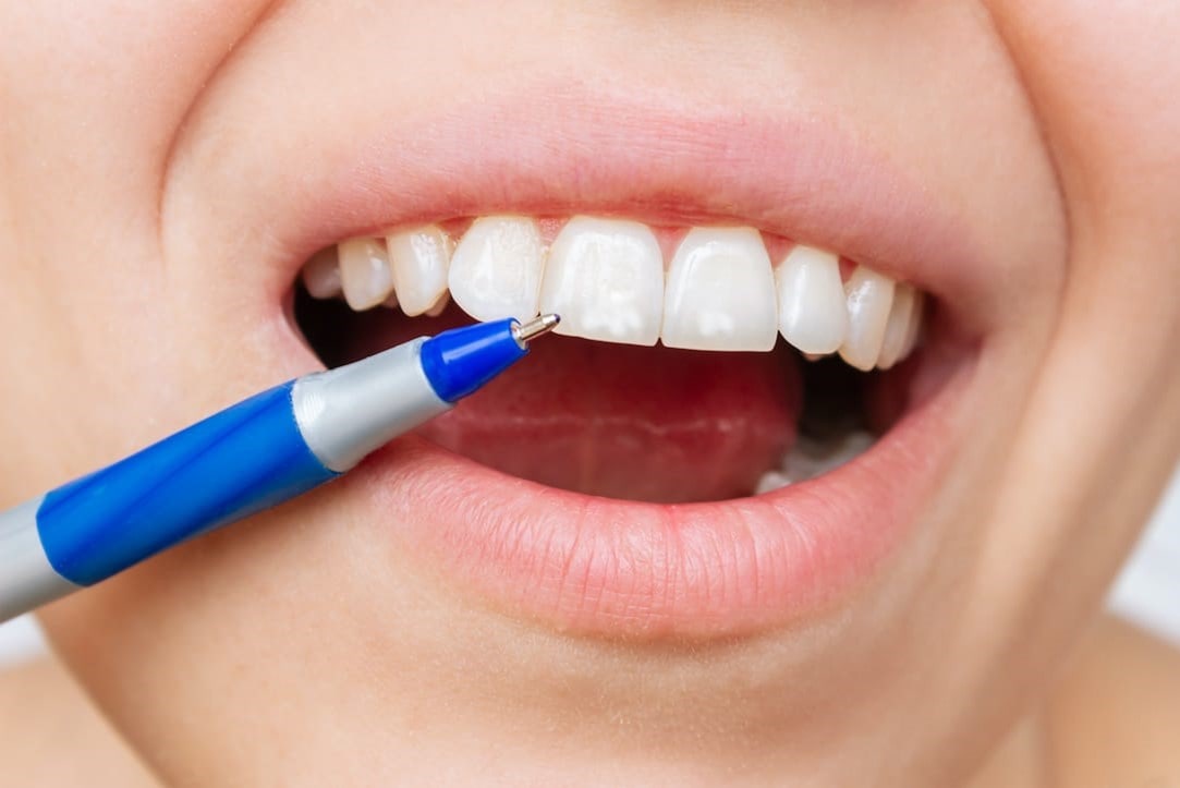 روش های تخصصی سفید کردن دندان ها