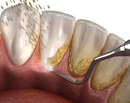 جرمگیری و تسطیح سطح ریشه چیست؟