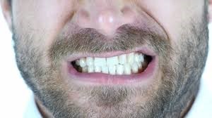 دندان قروچه چیست و چه تأثیری روی روکش دندان دارد؟