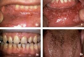 دهانشویه کلرهگزیدین ممکن است عوارض جانبی برای سلامتی داشته باشد