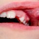 Picture42 80x80 - تأثیر آرتریت روماتوئید روی سلامت دهان و دندان و حتی ایمپلنت