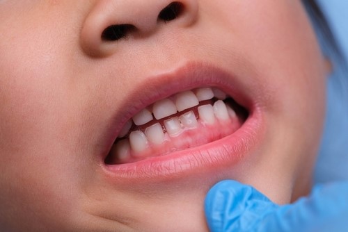 بیماری لثه روی سلامت کلی تأثیر می گذارد.