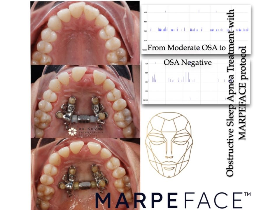 آیا گسترش اسکلتی فک بالا می تواند به بهبود آپنه خواب کمک کند؟ Picture2 1 960x720 - آیا گسترش اسکلتی فک بالا می تواند به بهبود آپنه خواب کمک کند؟
