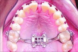 فواید انبساط فک برای تنفس فواید انبساط فک برای تنفس