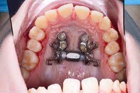 گسترش سریع کام با کمک جراحی (SARPE) گسترش سریع کام با کمک جراحی (SARPE)